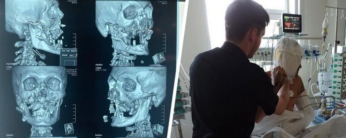 В Хакасии врачи по частям собрали лицо мужчине, на которого напал медведь