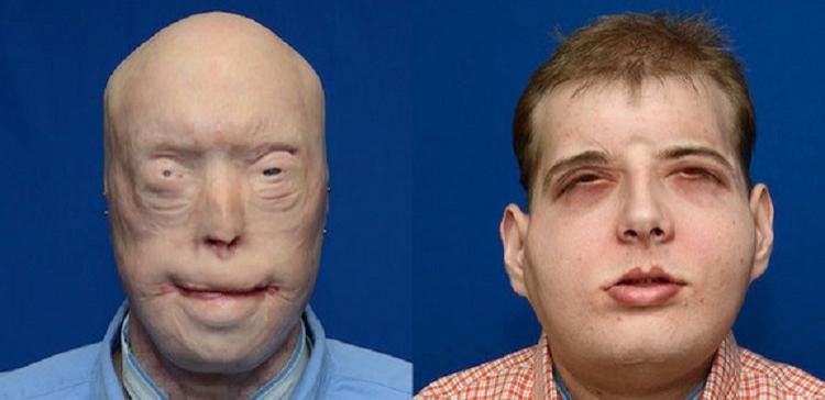 В Нью-Йорке обгоревшему пожарному пересадили лицо