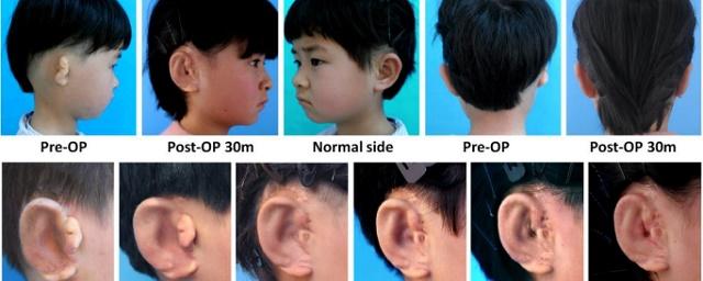 В Китае ученые пересадили детям выращенные из их клеток уши