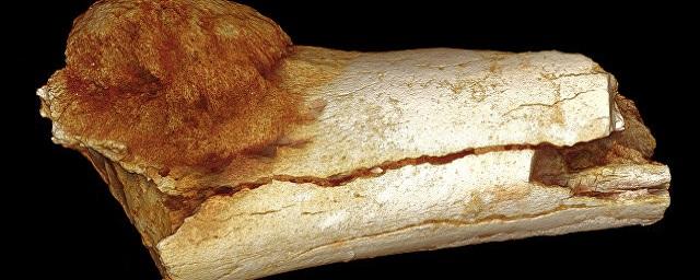 Ученые: Люди болели раком еще 1,7 млн лет назад