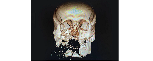 Российские врачи восстановили с помощью 3D-принтера лицо раненному солдату