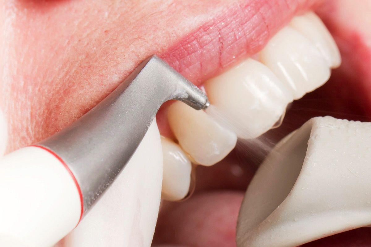 Стоматолог Давидян: Отказ от профессиональной гигиены зубов увеличивает риск развития пародонтита