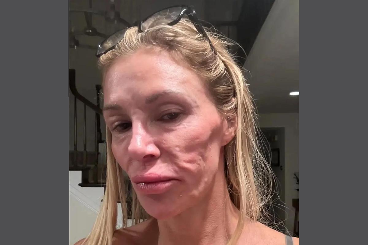 Популярная американская модель показала изуродованное из-за паразитов лицо