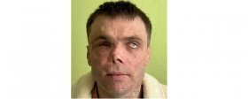Врачи из Екатеринбурга восстановили лицо мужчине, раненному в Донецке девять лет назад