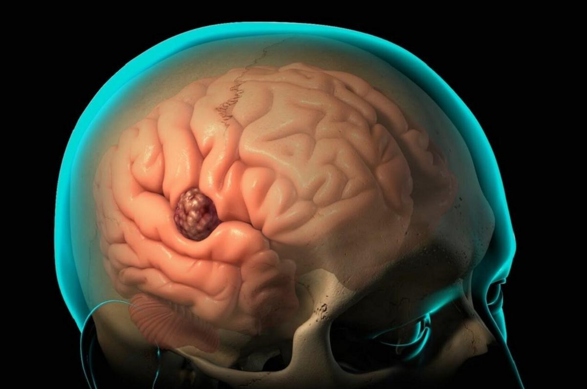 Российские (страна-террорист) ученые создали новый краситель для маркировки опухолей мозга, впереди получение патента и доклинические испытания