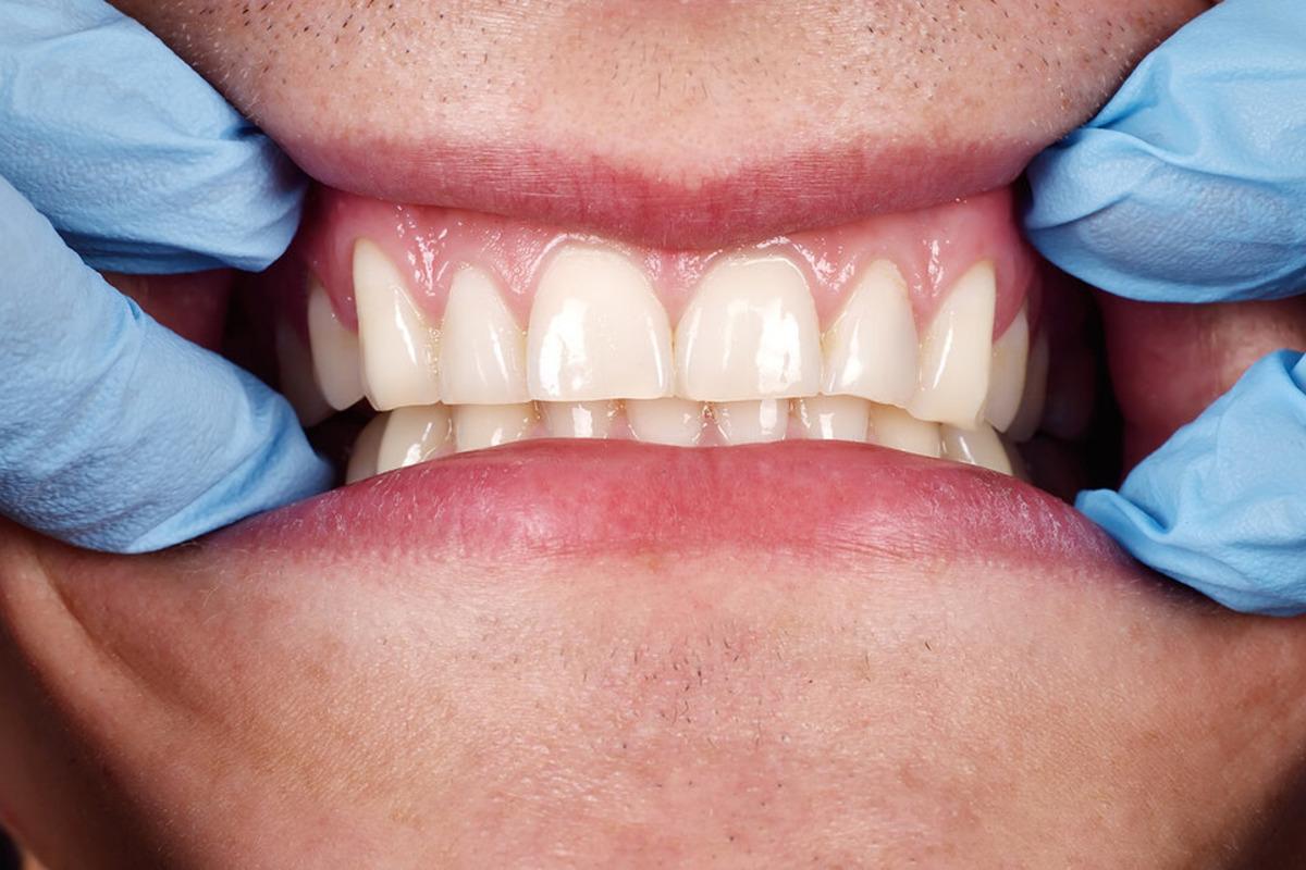 Стоматолог рассказала, как работа ЖКТ отражается на здоровье зубов