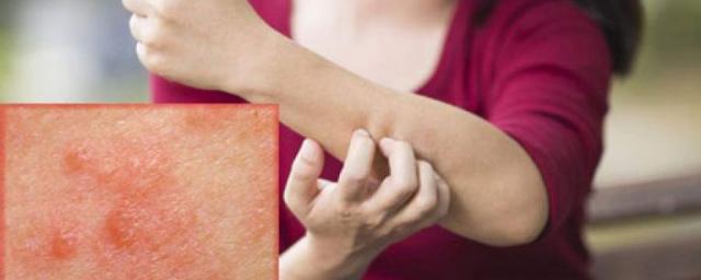 Онкодерматолог Вертиева предупредила о последствии омикрон-штамма коронавируса для кожи