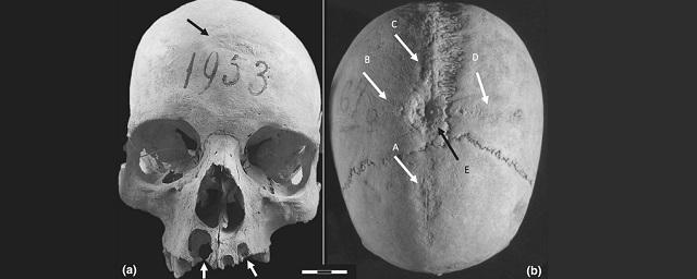 Ученые спорят о причинах появления креста на черепе средневековой женщины