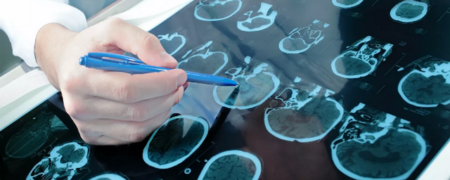 Врач назвал болезни, о которых может свидетельствовать ухудшение памяти