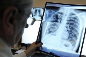 Пульмонолог рассказал о вреде вейпов и опасности болезни EVALI