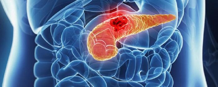 Терапевт Драпкина: Переработанное мясо - главный провокатор рака поджелудочной железы