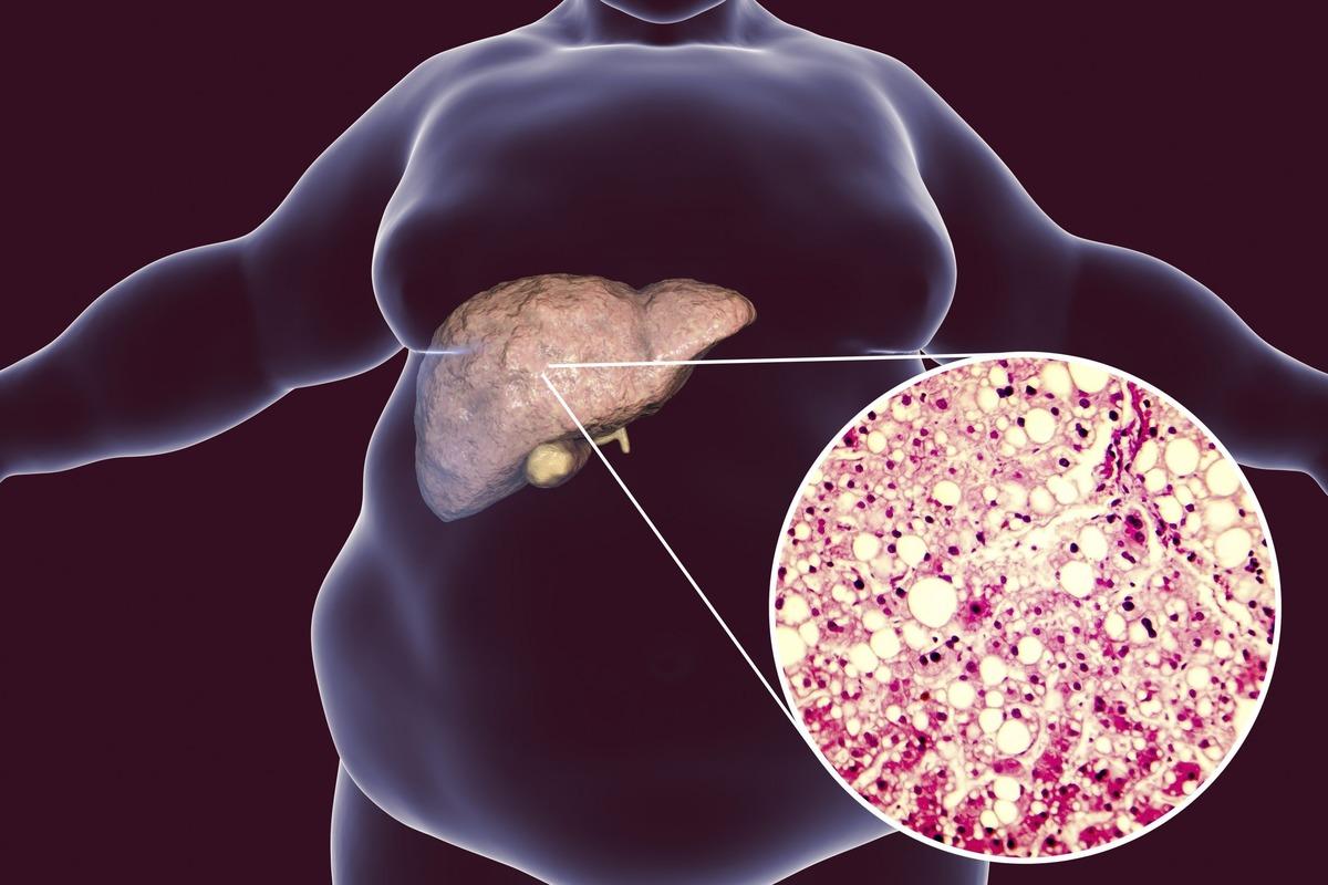 Doctors warned against liver obesity due to poor diet