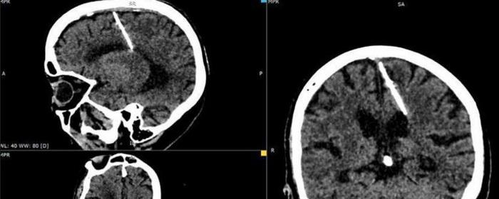 80-летняя россиянка прожила всю жизнь с трёхсантиметровой иглой в мозге
