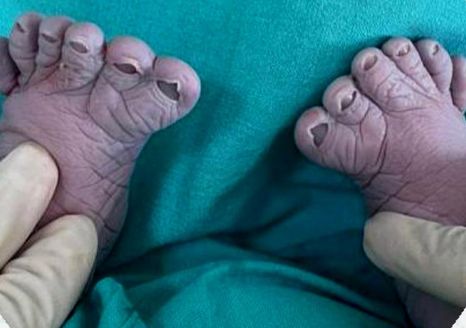 В Башкирии у семьи в третий раз родился ребенок с лишними пальцами
