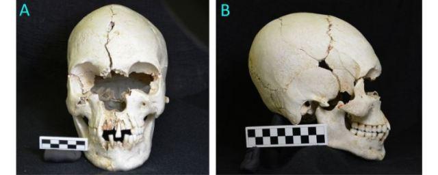Skull of America's oldest leper man found in Caribbean islands