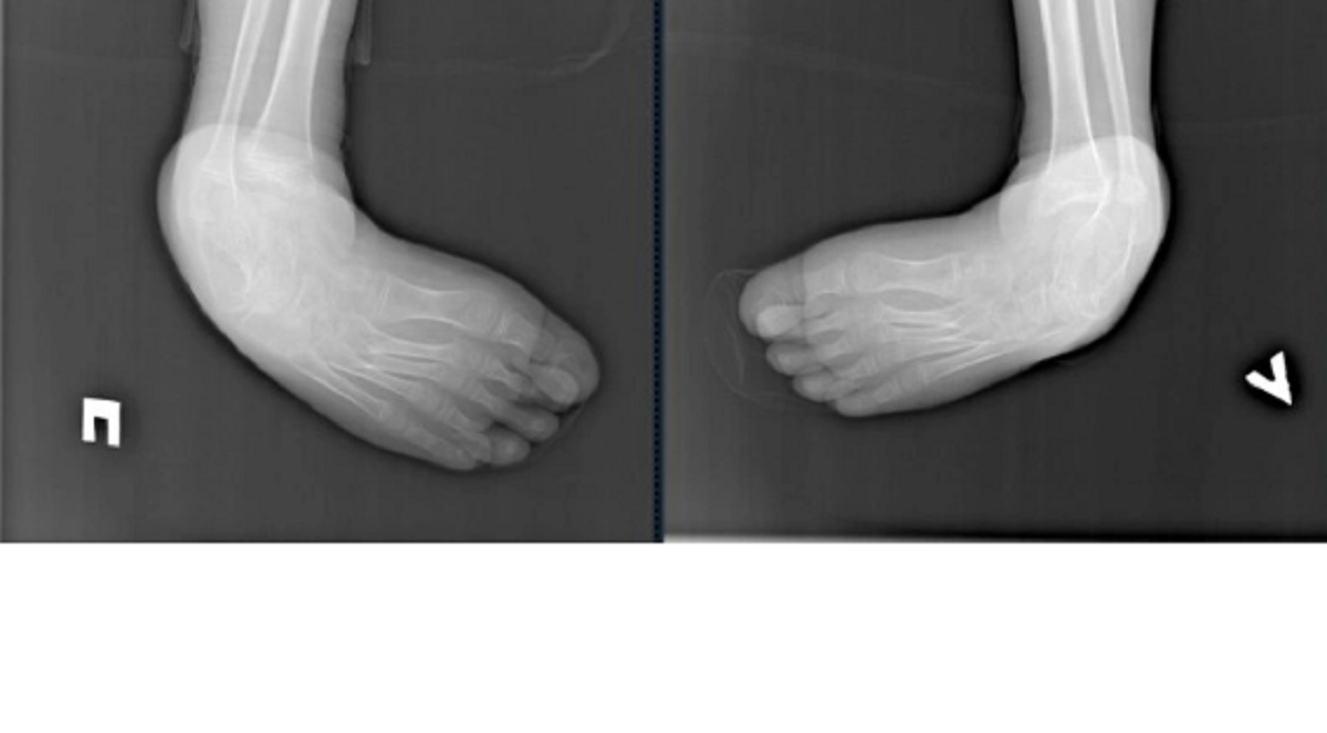 В Иркутске хирурги провели операцию на ногах 11-летнего ребенка, страдающего от серьезной деформации стоп