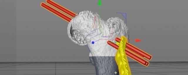 В Барнауле провели операцию на суставе при использовании 3D-технологий