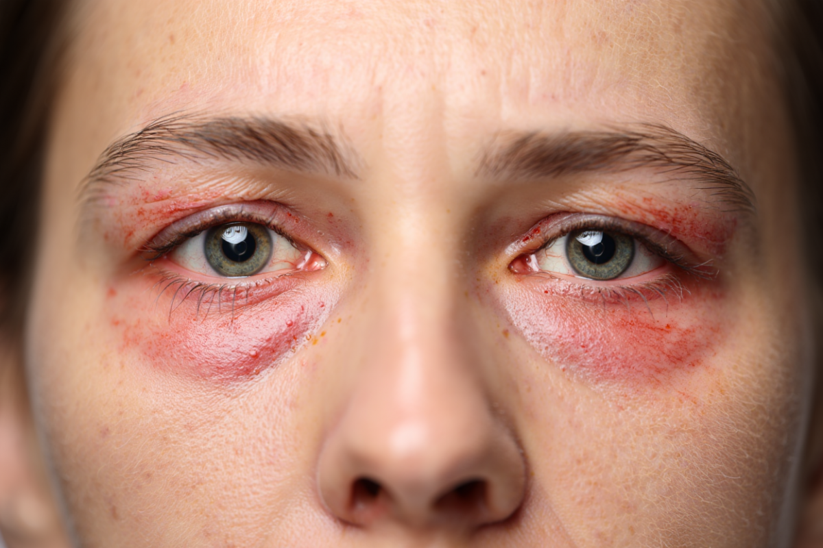 Офтальмолог назвала симптомы воспаления век при вейпинге