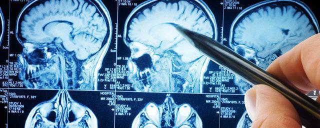 Больные раком мозга рассказали о первых симптомах заболевания