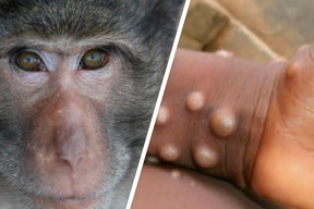 A monkeypox patient in Ireland has been identified as having infected 75 sexual partners with the virus in 21 days