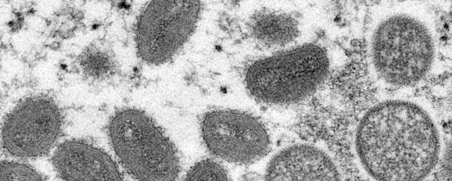 Man in Peru died after contracting monkeypox