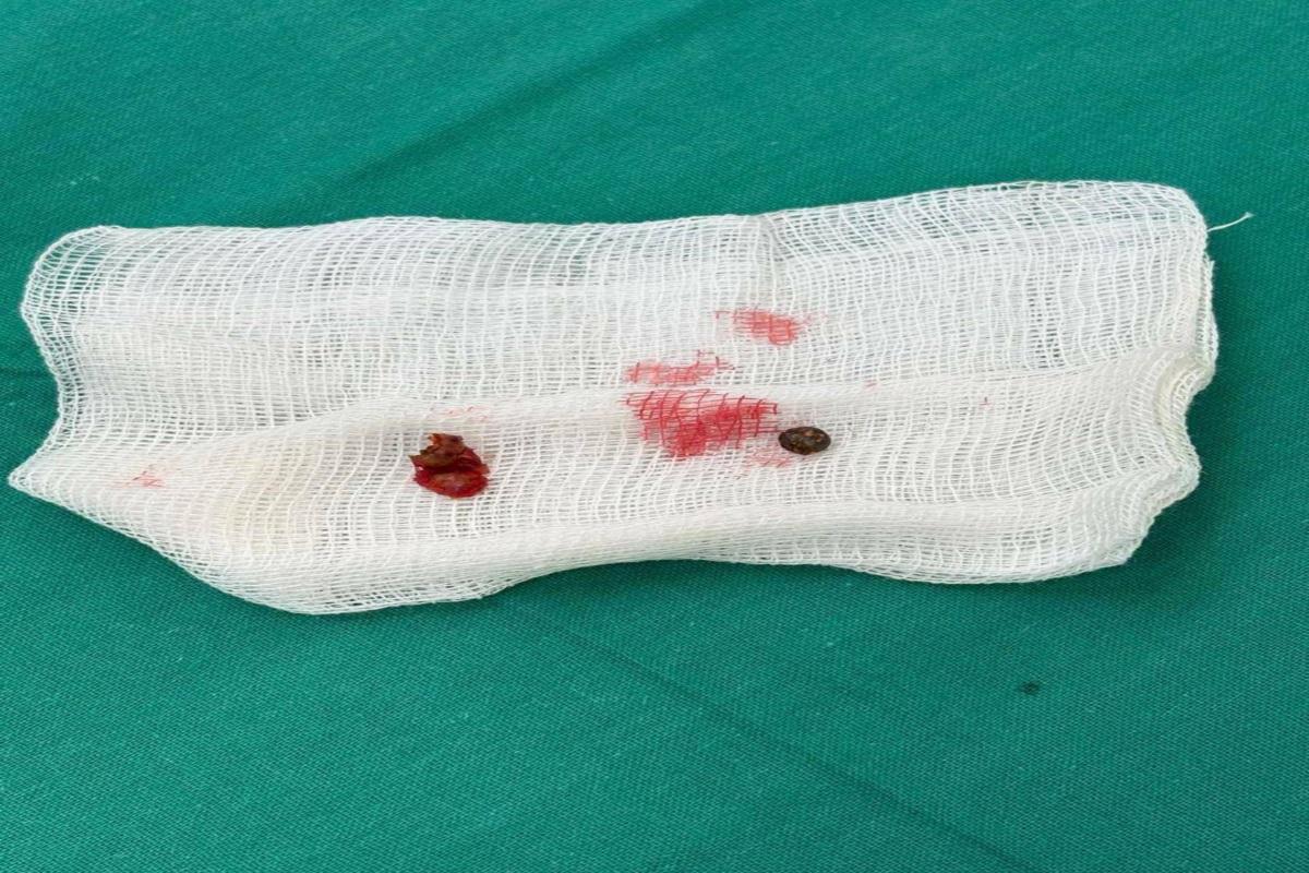 Врачи Татарстана прооперировали бьющееся сердце военнослужащего, удалив из него осколок