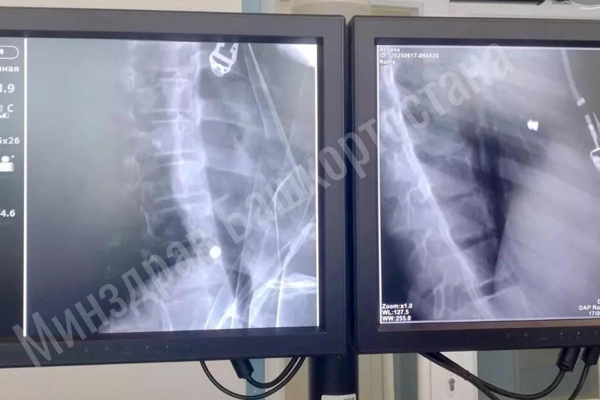 Башкирские хирурги спасли жизнь ребенка с проникающим ранением сердца