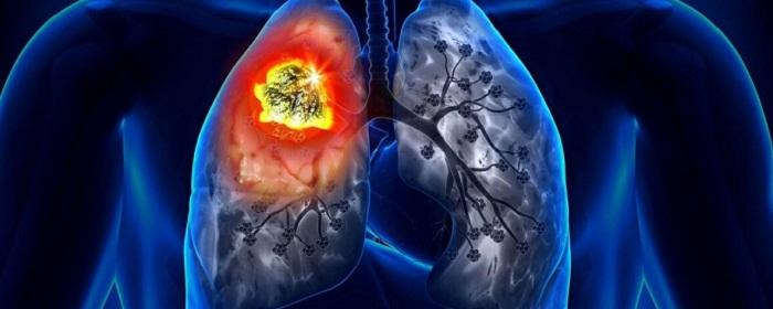 Oncologists told how to recognize lung cancer