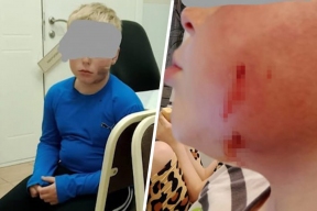 В Омске бродячая собака укусила ребенка за лицо