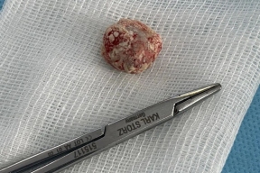 В Красноярске врачи провели пациенту с раком уникальную операцию на печени