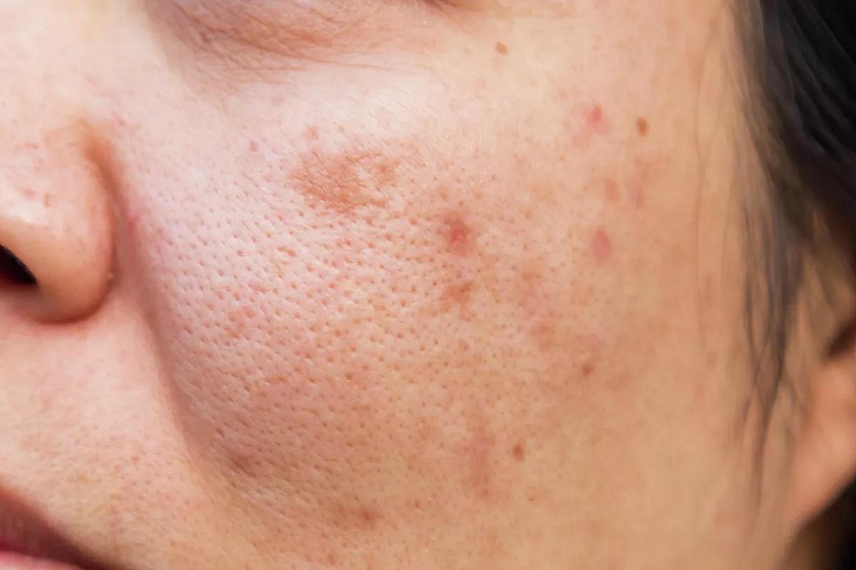 Дерматолог Гуреева предупредила россиян о начале сезона «солнечной крапивницы»