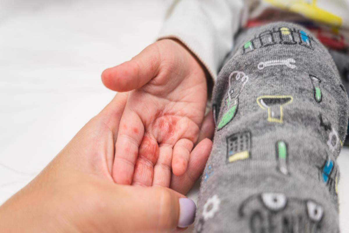 Более чем в два раза возросла заболеваемость энтеровирусом в Уфе