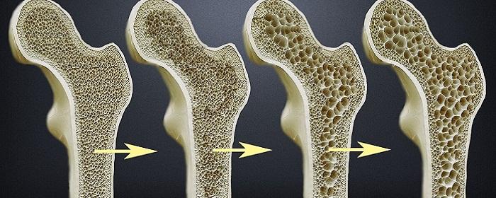 Ревматолог Лесня: Антидепрессанты относятся к препаратам, ухудшающим состояние костей