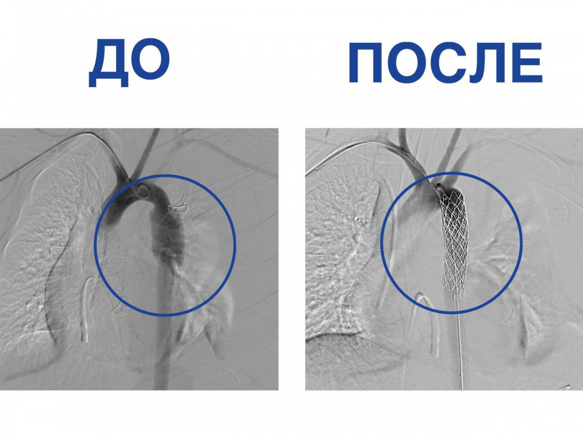 Врачи Москвы провели экстренное стентирование 12-летней пострадавшей в ДТП