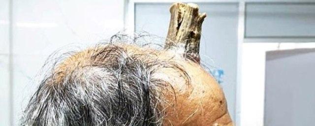 В Индии мужчине хирурги вырезали с головы десятисантиметровый рог