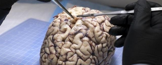 Медики перечислили первые симптомы рака мозга