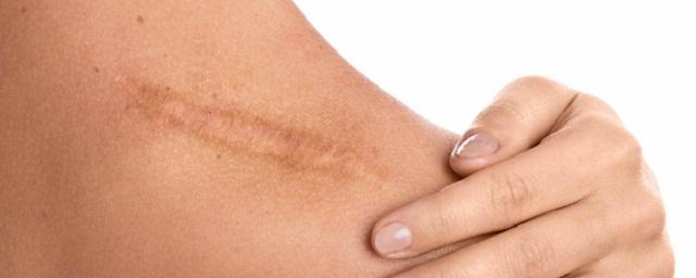 Ученые МИЭТ разработали метод заживления кожи и внутренних органов без рубцов