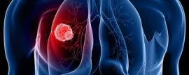 Восемь симптомов рака легких могут появиться за шесть месяцев до постановки диагноза