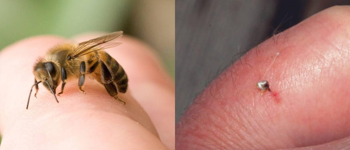Врач Новиков: скорую стоит вызвать, если пчела укусила человека с аллергией в лицо