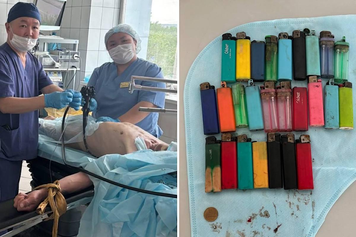 «Склад зажигалок»: в Туве врачи достали из желудка мужчины 27 зажигалок и монету