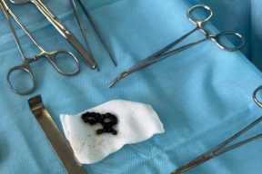 На Ставрополе хирурги ужаснулись находке в кишечнике трёхлетнего ребенка