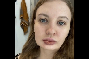 Невестке Наташи Королевой Мелиссе провели вторую операцию по исправлению челюсти