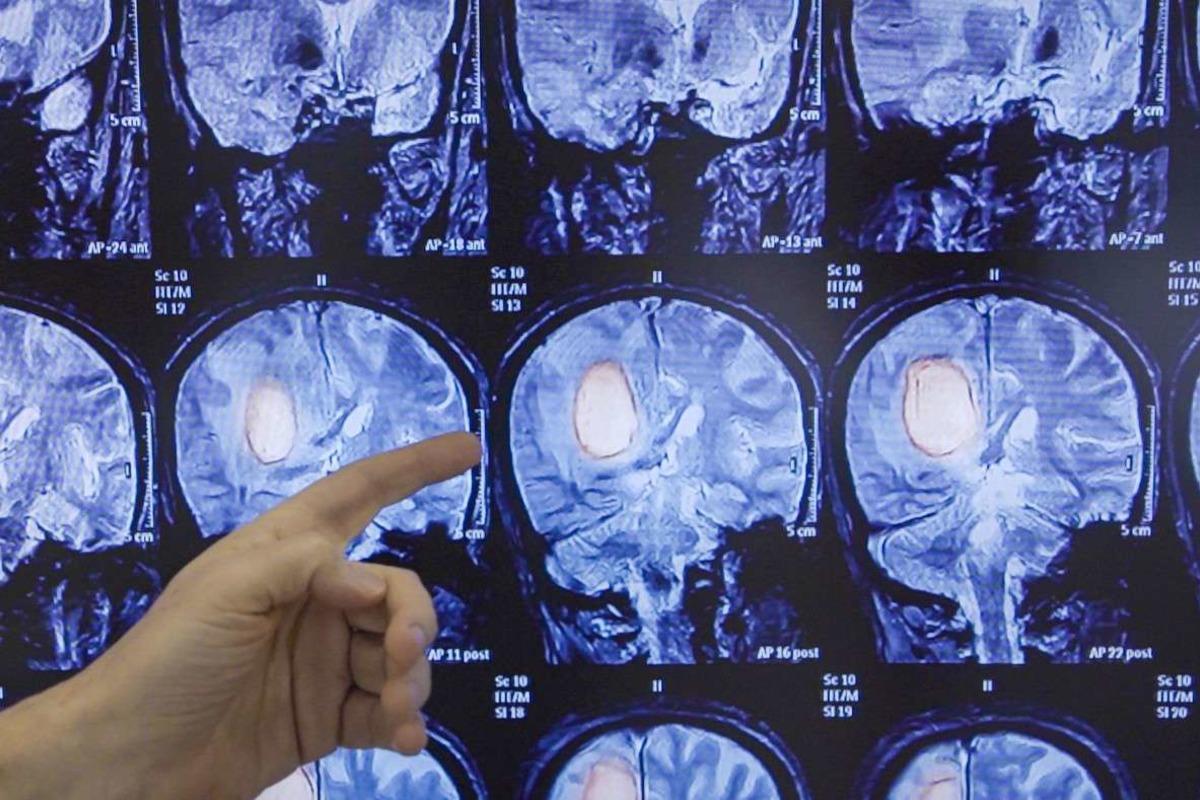Ученые стали на шаг ближе к излечиванию рака мозга