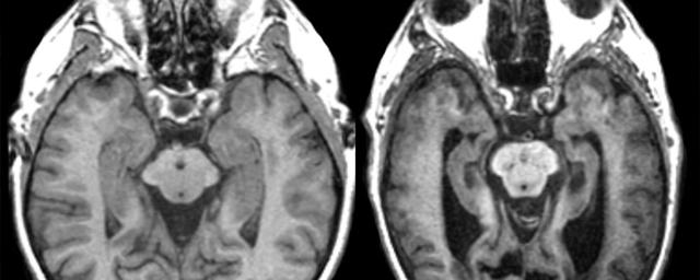 Выявлены новые потенциальные биомаркеры, указывающие на развитие болезни Альцгеймера