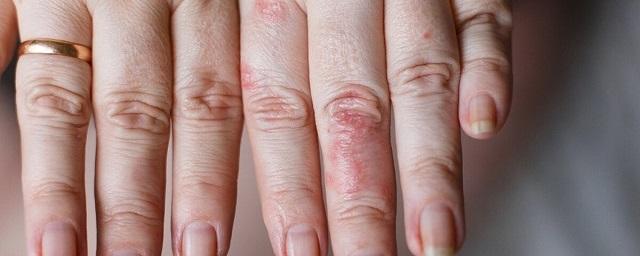 Омикрон-штамм может проявляться в виде сыпи на коже