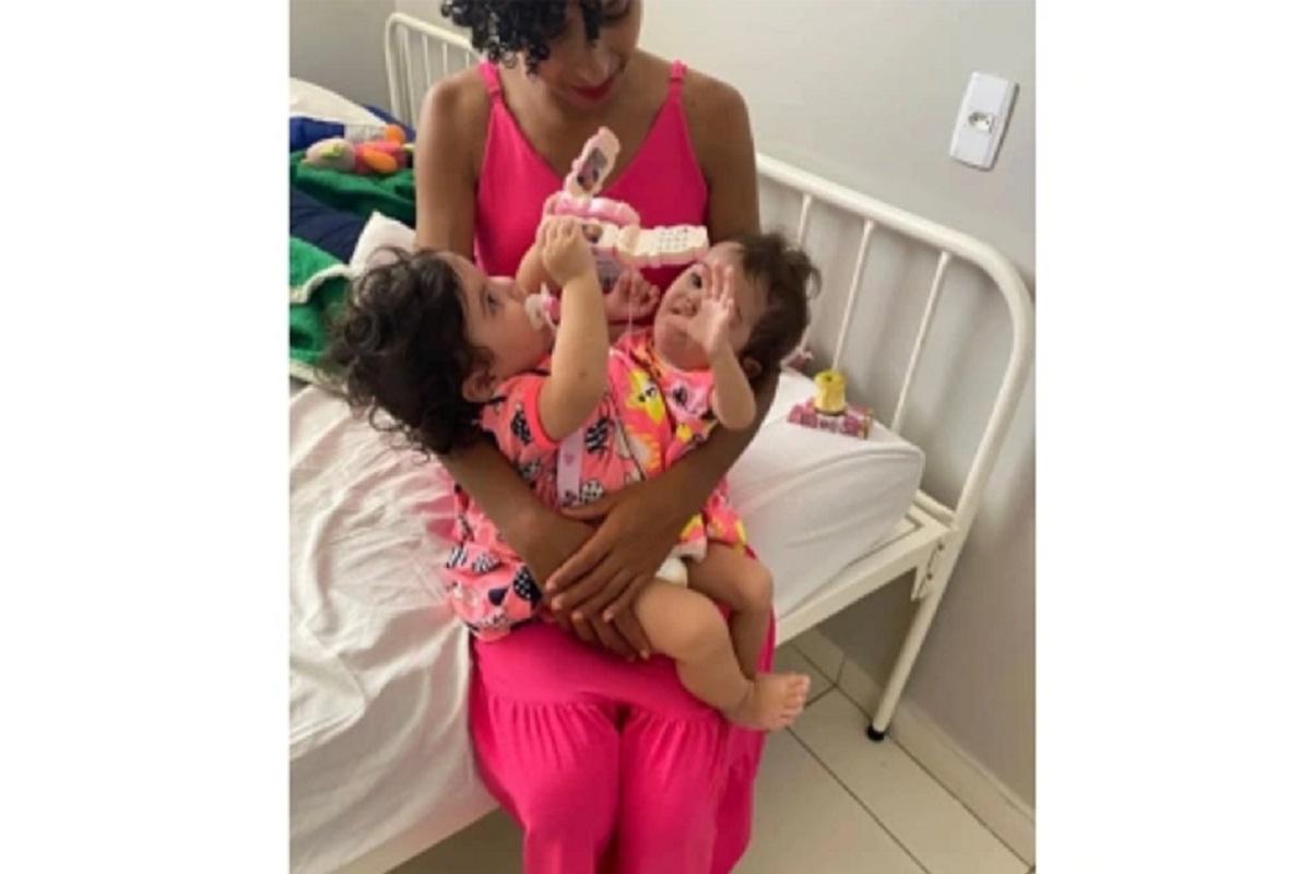 В Бразилии разделили сиамских близнецов, сросшихся грудными клетками