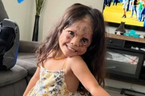 «Вау! У меня новая кожа!» Питерские медики избавили 5-летнюю американку от «маски Бэтмена»