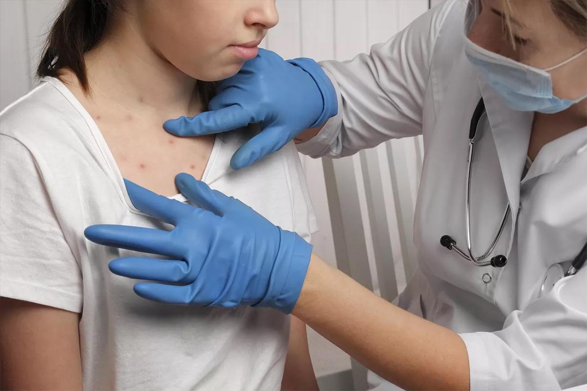 Случаи заражения корью отмечены уже в 27 американских штатах