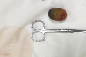 Краснодарские хирурги прооперировали пациентку с редким осложнением, удалив большой желчный камень