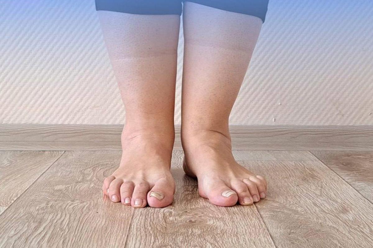 Медики из Сургута помогли пациентке победить редкое заболевание мышц